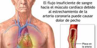 anginapecho