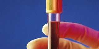 detectar-sindrome-de-Down