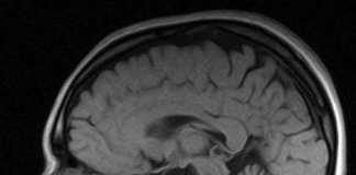 enfermedad-de-Alzheimer
