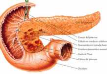 pancreatitis