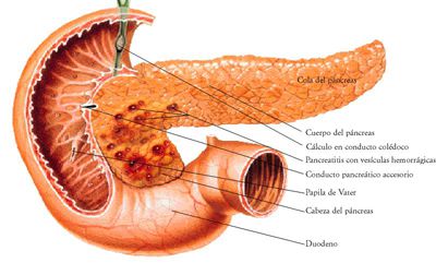 pancreatitis