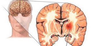 Que-ocurre-cuando-se-produce-un-ictus