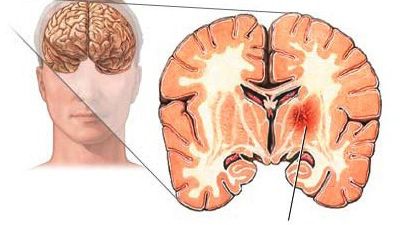 Que-ocurre-cuando-se-produce-un-ictus