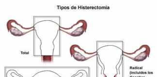 histerectomia