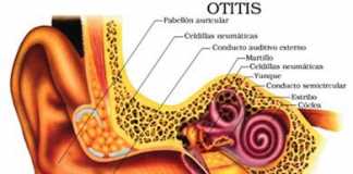 otitis