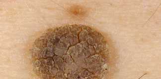 precancerosas