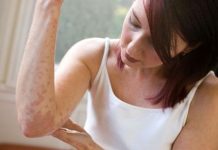 Consejos-para-la-dermatitis-atopica