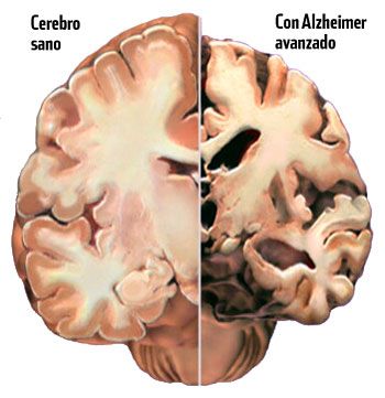 Cerebros inmunes a la enfermedad de alzhéimer alzeimer