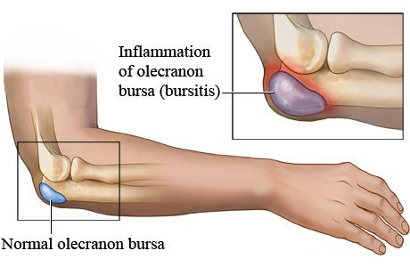 bursitis