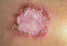 impetigo