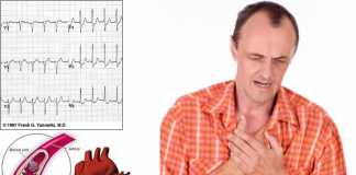 infarto