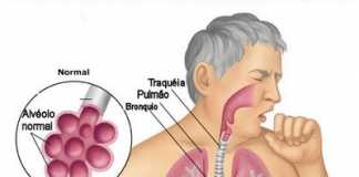 neumonia