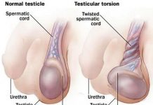 Qué es la torsión de testículo torsiontesticulos