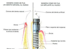 implante-dental