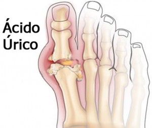 Cómo prevenir la gota prevenirgota