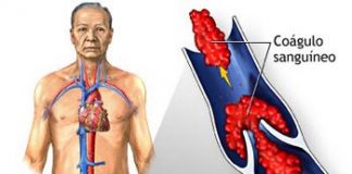 Consejos-para-prevenir-coagulos-sanguineos
