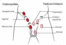 La criptorquidia podría aumentar las probabilidades de cáncer criptorquidia