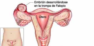 ectopico