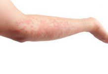 La urticaria, sindrome o enfermedad urticariasindrome