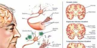 Alzheimer