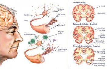 Un tratamiento prometedor para la enfermedad de Alzheimer Alzheimer