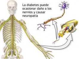 Prevenir-la-neuropatia-diabetica