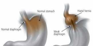 herniahiato