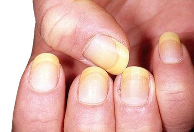 El-color-y-forma-de-las-unas-ayudan-a-diagnosticar-ciertas-enfermedades