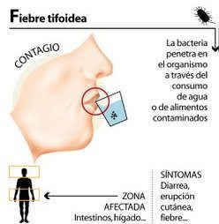 Prevenir la fiebre tifoidea Prevenir-la-fiebre-tifoidea
