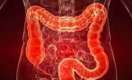 cancercolon
