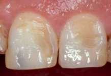 Cómo prevenir la erosión del esmalte dental esmalte