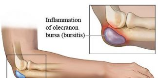 Como-tratar-la-bursitis