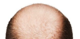 alopeciahombres