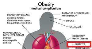 diabesidad
