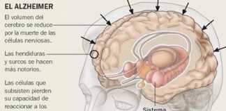 enfermedad-de-Alzheimer