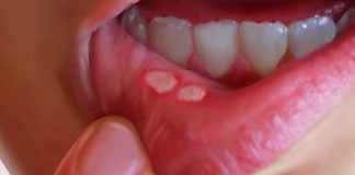 diabetes-boca