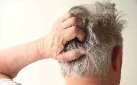 dermatitisseborreica