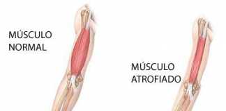 distrofia-muscular