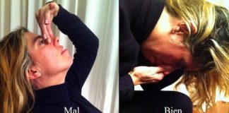 epistaxis