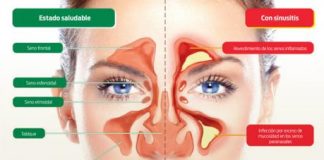 sinusitis