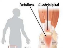 tendinitisrodilla
