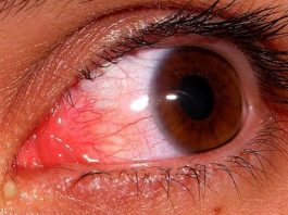 derrame-ocular