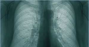 bronquiectasia