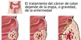 cancercolon