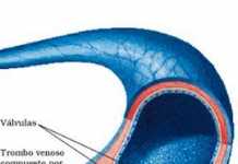 trombosis