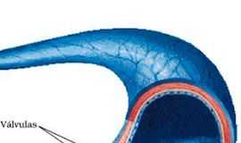 trombosis