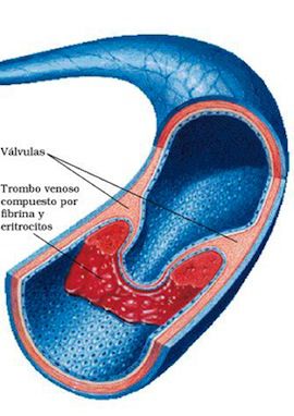 trombosis