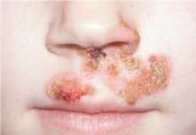 impetigo