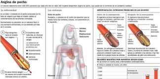angina