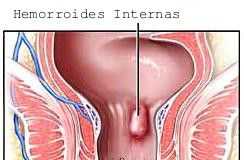 hemorroidesinternas